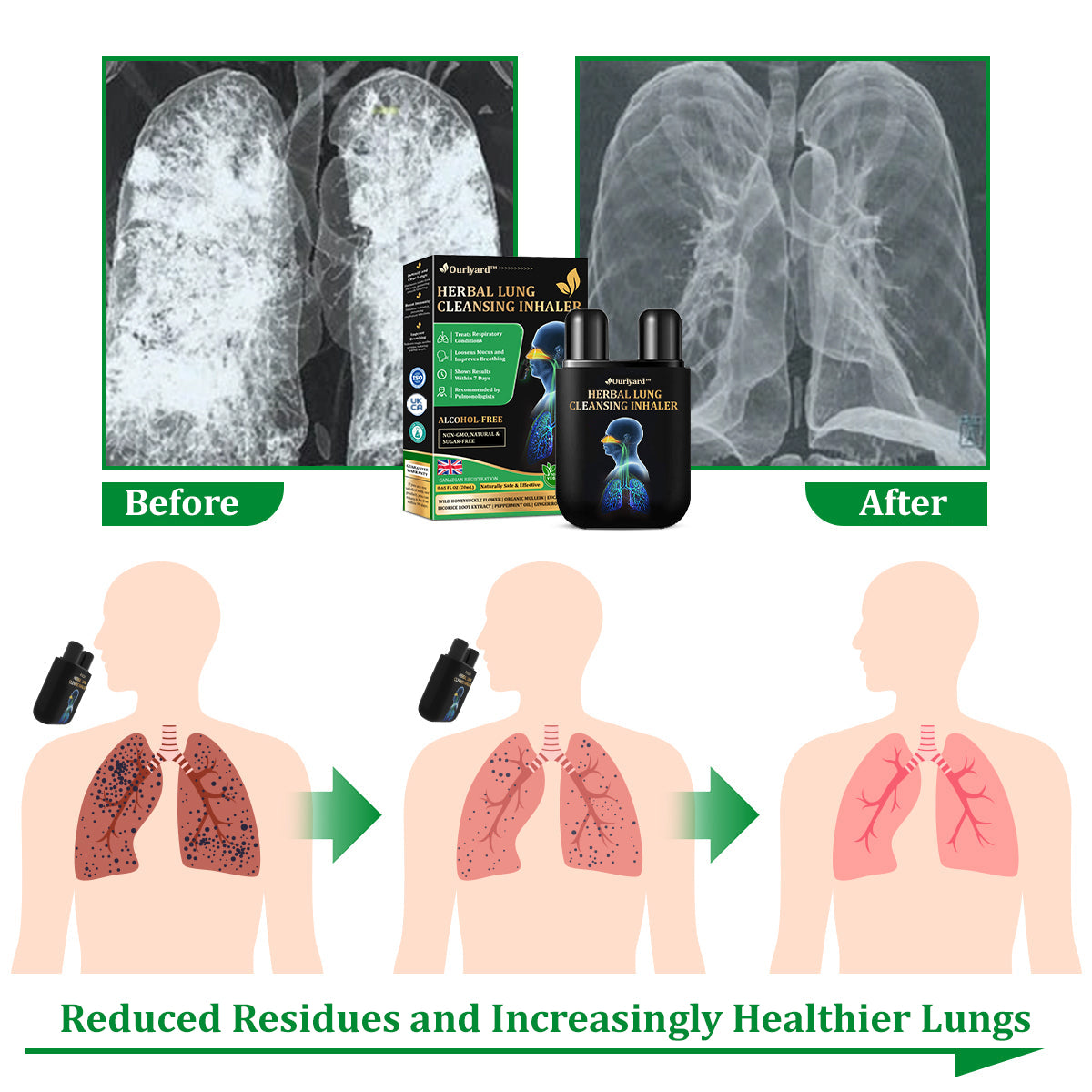 🍒✅Official Store:Ourlyard™ Herbal Lung Cleansing Inhaler 🫁MHRA Approved(💝 Cough, wheezing, shortness of breath, sputum, stuffy nose, bronchitis, bronchitis, allergy symptoms, lung discomfort💝)